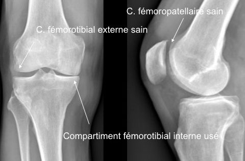 Radiographie : usure isolée d'un compartiment