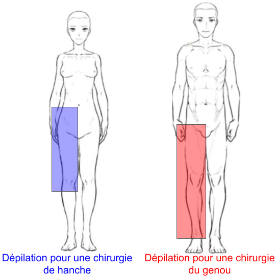 Zone dépilatoire en chirurgie de hanche et de genou
