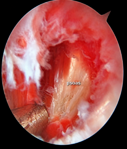 Vue endoscopique du tendon du psoas avant ténotomie