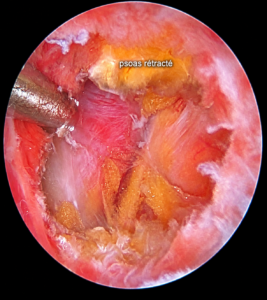 Vue endoscopique du psoas rétracté après ténotomie